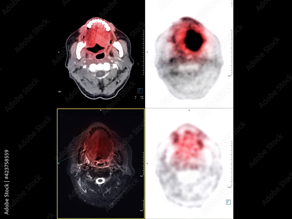 PET CT image of the Neck showing CA nasopharynx or carcinoma of ...