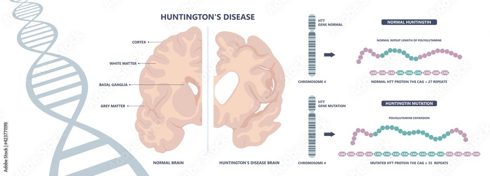 Obraz premium Huntington parkinson Motor alzheimer neuron brain DNA gene nerve cell juvenile problem defect genetic basal ganglia neuro repeat mutant damage testing defective mood inherits system family memory loss