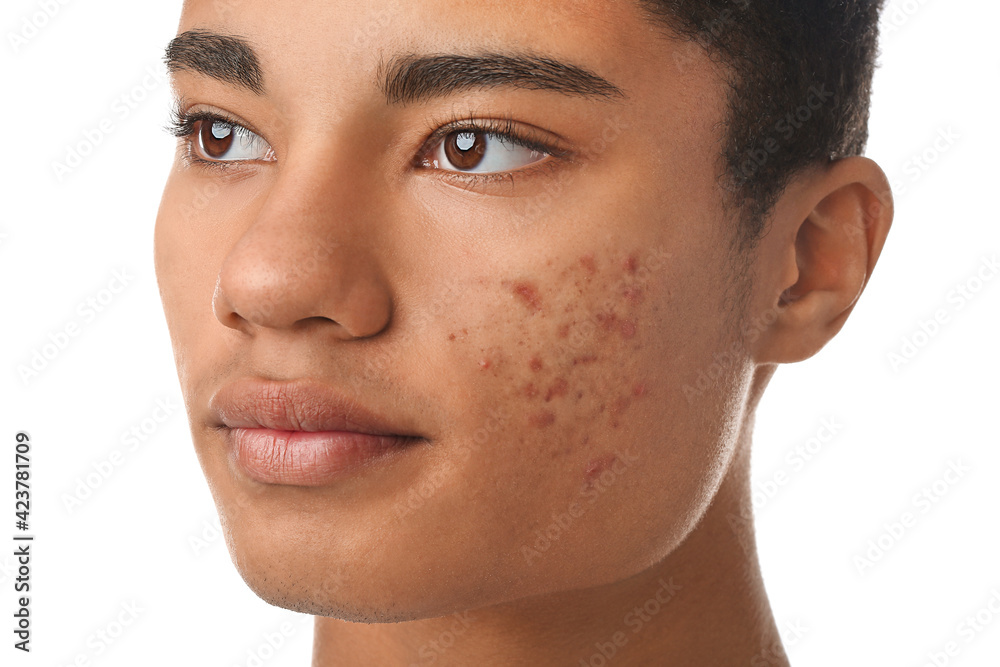 African-American teenage boy with acne problem on white background African-American teenage boy with acne problem on white background