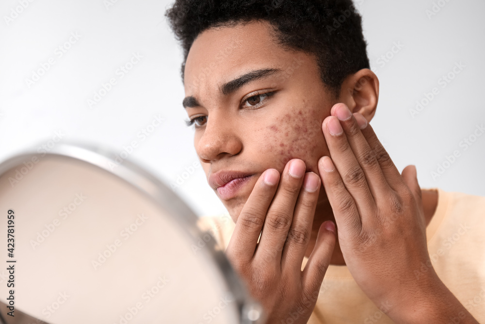African-American teenage boy with acne problem at home African-American teenage boy with acne problem at home