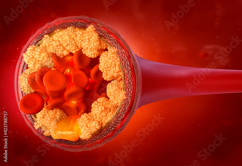 Cholesterol in the blood vessels. Atherosclerosis disease 3D illustration: atherosclerotic plaque, blood cells, red background. High LDL cholesterol in the arteries. Health risk, blood press control photo