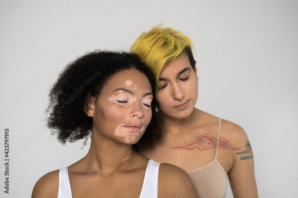 Vitiligo skin girl and woman with color skin and tattoos posing together