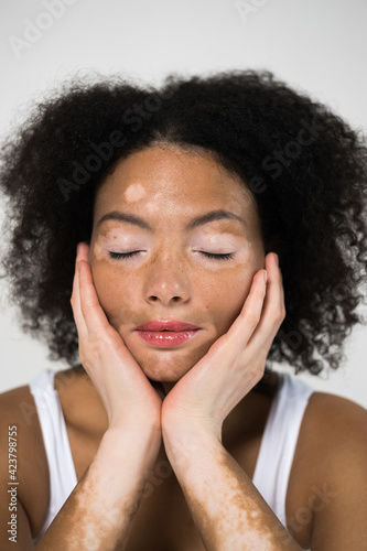 Curly woman with vitiligo disease skin sitting with closed eyes at the studio