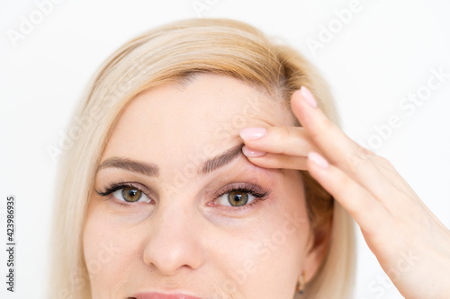 woman shows drooping eyelid for plastic surgery photo