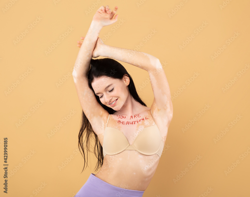 You are beautiful inscription on chest of happy young lady with vitiligo You are beautiful inscription on chest of happy young lady with vitiligo