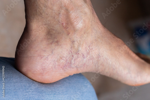Adult man's foot with varicose veins