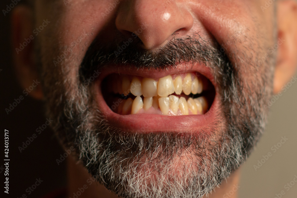 Mouth of bearded man showing crooked teeth Mouth of bearded man showing crooked teeth
