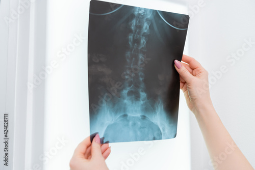 cropped view of rehabilitologist holding x-ray in hospital photo