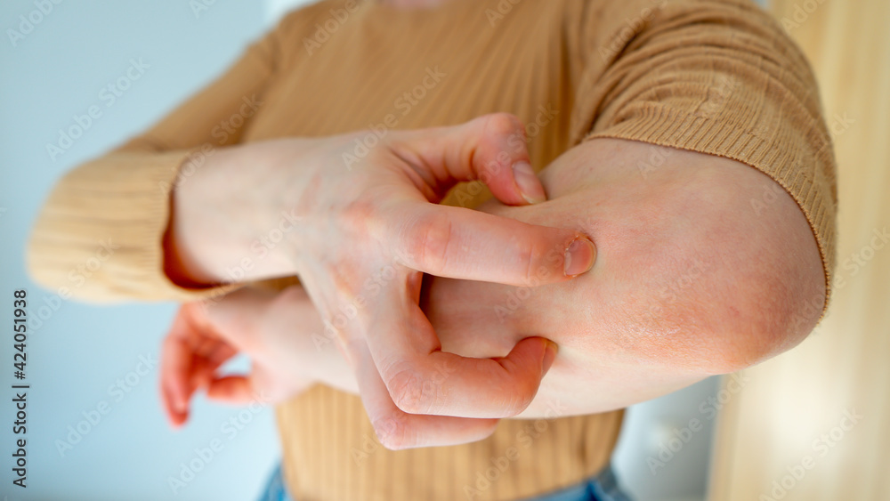 Naklejka premium Young woman scratches the itching on her hands with a reddening rash. Itching is caused by dermatitis (eczema), dry skin, burns, food, drug allergies, insect bites. Health care concept.