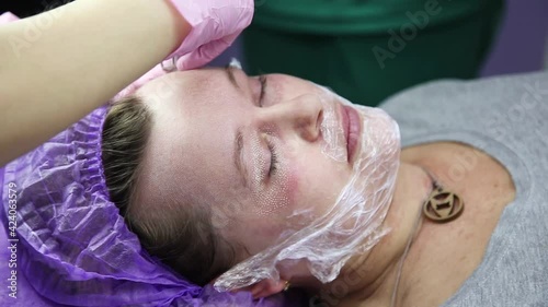 face having a laser skin treatment, a resurfacing technique for wrinkles