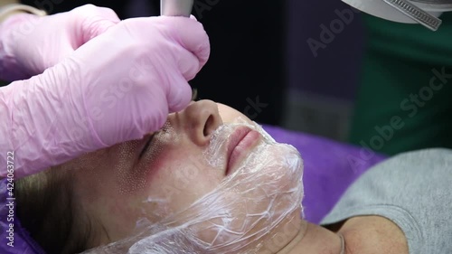 face having a laser skin treatment, a resurfacing technique for wrinkles