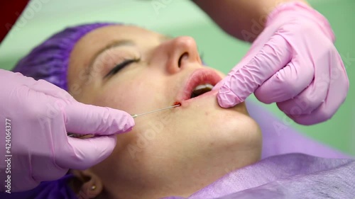 lip augmentation procedure. beauty injections. Plastic surgery