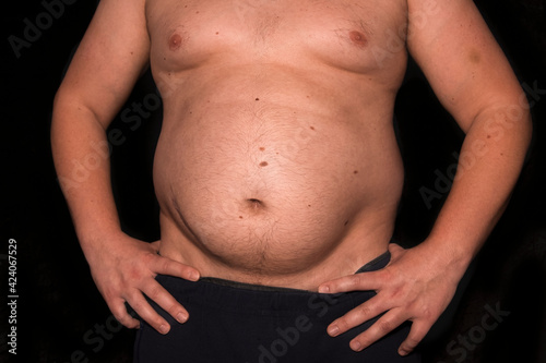 A young man with obesity and a big belly.