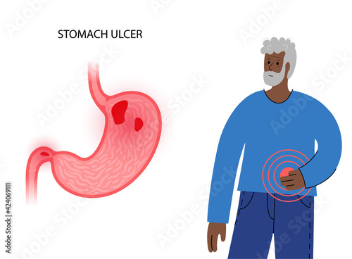 Stomach ulcer concept