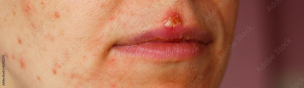 problem face, acne, herpes on the lip. Herpes simplex virus is an infection. Young woman shows her face with acne, dry lips. Health problems, skin diseases. problem face, acne, herpes on the lip. Herpes simplex virus is an infection. Young woman shows her face with acne, dry lips. Health problems, skin diseases.