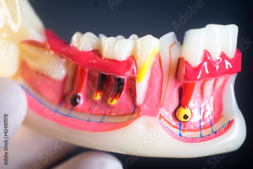 Картината върху платно Tooth decay dental model