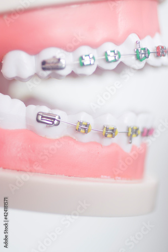 Dental teeth aligners brackets