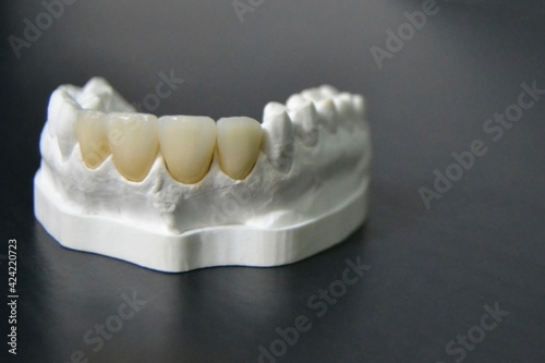 White front teeth veneers on diagnostic model on dark background