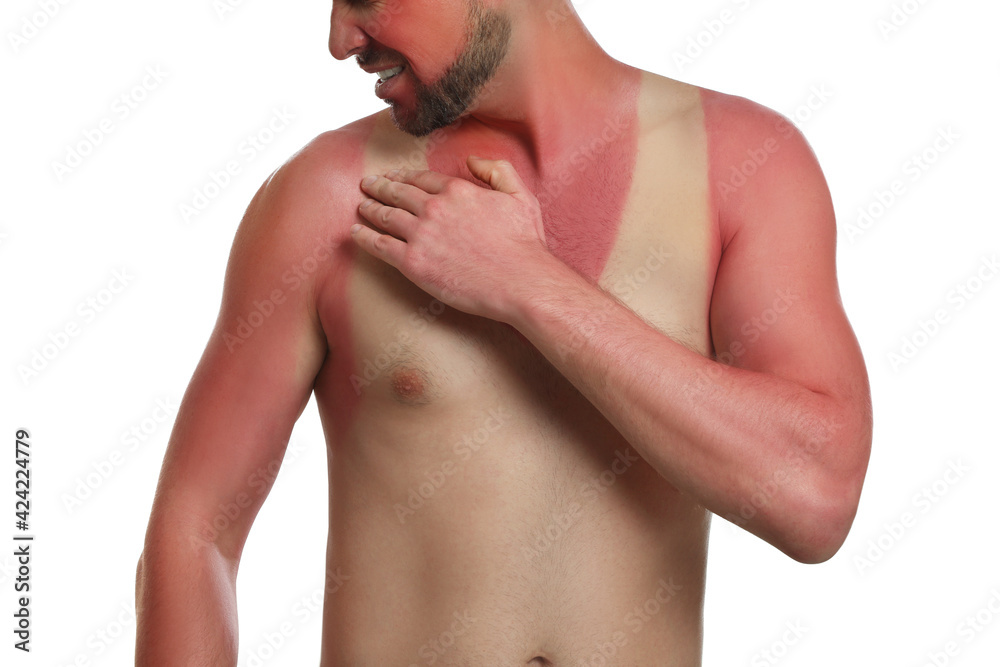 Man with sunburned skin on white background, closeup Man with sunburned skin on white background, closeup