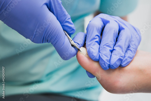 
Professional pedicure using a corrective brace. A podiatrist doctor treats a patient's ingrown toenail. photo