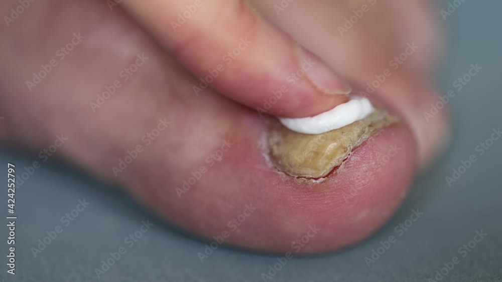 The fingers of the hand apply the ointment to the nail fungus on the big toe The fingers of the hand apply the ointment to the nail fungus on the big toe