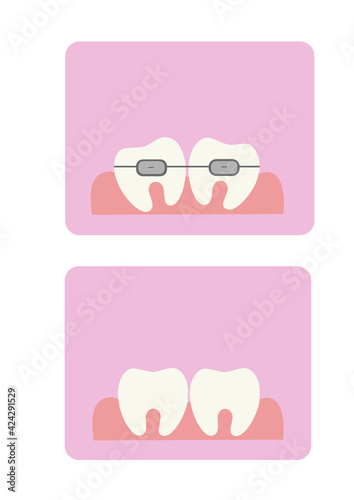 
Vector illustration of teeth on a pink background. Braces and straight teeth after wearing braces. White, even teeth. Dentistry.