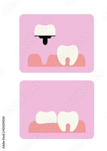 Vector illustration of teeth on a pink background. Dental implants. Dental implantation surgery. White, even teeth. Dentistry.