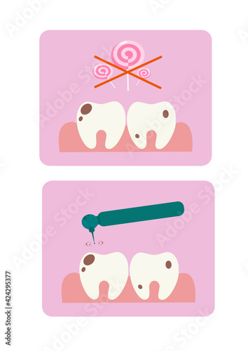Vector illustration of teeth on a pink background. Caries from sweets. Consequences of eating sweets. Bad teeth. No candy. No sweets. Dentistry. Teeth drilling machine. Treat tooth decay.