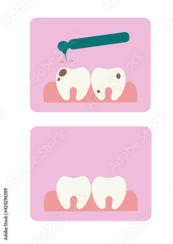Vector illustration of teeth on a pink background. Caries from sweets. Consequences of eating sweets. Bad teeth.
Sugar harm. Poor care and its consequences. Dentistry. Teeth drilling machine. Teeth st