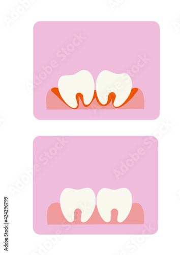 Vector illustration of teeth on a pink background. Bleeding. Periodontal disease. Bad teeth.
Poor care and its consequences. Before and after the treatment of periodontal disease. Dentistry.
