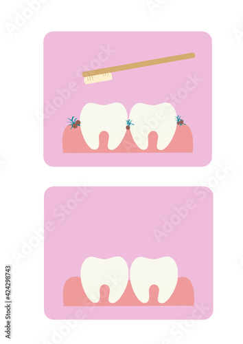 Vector illustration of teeth on a pink background. Brushing your teeth with a toothbrush. Proper dental care. Parsley in my teeth. Leftover food between teeth. Oral hygiene. Dentistry.