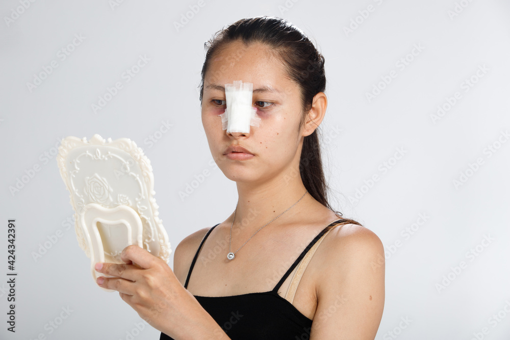 Asian woman did Nose plastic surgery to lift up shape, Rhinoplasty Asian woman did Nose plastic surgery to lift up shape, Rhinoplasty