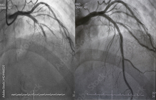 Foto Comparison of pre-post percutaneous coronary intervention (PCI) at proximal to mid left anterior descending artery (LAD) with drug eluting stent (DES)