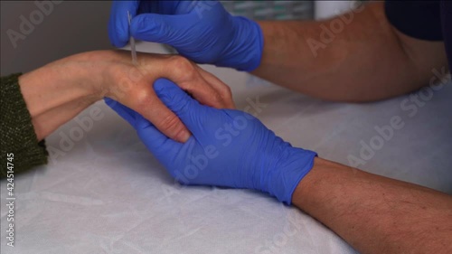 Physiotherapy session, using the Dry Needling technique, to treat rhizarthrosis, puncturing the opponens pollicis muscle of the thumb and the first interosseous muscle. photo