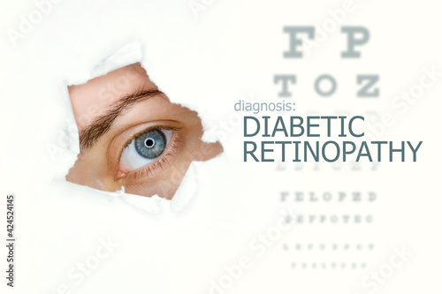 Woman`s eye looking trough teared hole in paper, eye test with words Diabetic Retinopathy on right. Eye disease concept template. Isolated white background.