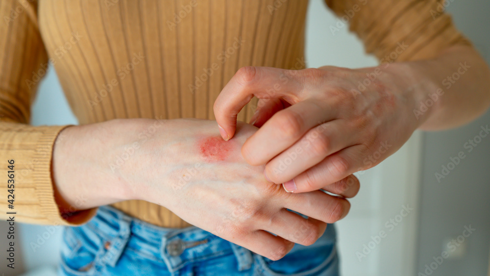 Young woman scratches the itching on her hands with a reddening rash. Itching is caused by dermatitis (eczema), dry skin, burns, food, drug allergies, insect bites. Health care concept.