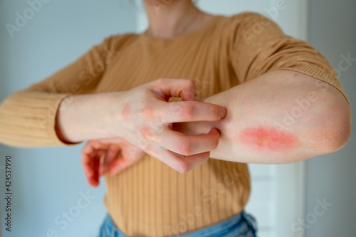 Young woman scratches the itching on her hands with a reddening rash. Itching is caused by dermatitis (eczema), dry skin, burns, food, drug allergies, insect bites. Health care concept.