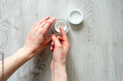 Women's hands smeared with cream. Dermatitis on the hands. Dermatitis Remedies. Applying the ointment , creams in the treatment of eczema, psoriasis and other skin diseases