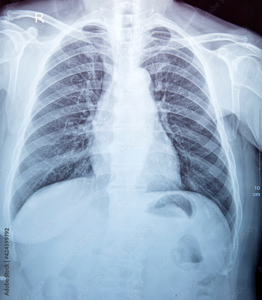X-Ray Image Of Human Chest for a medical diagnosis X-Ray Image Of Human Chest for a medical diagnosis