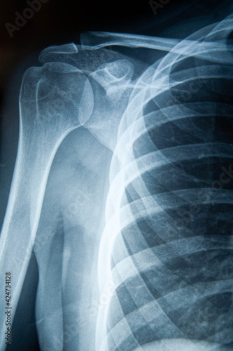 Radiografía del cuerpo humano, hombro.