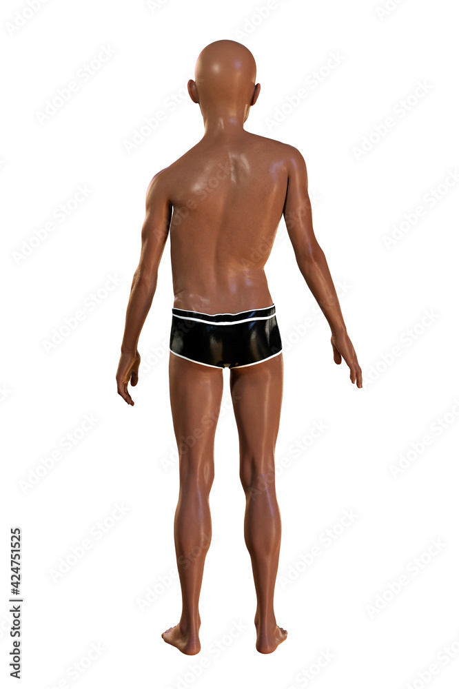 A boy with scoliosis, 3D illustration. Spine curve anatomy A boy with scoliosis, 3D illustration. Spine curve anatomy