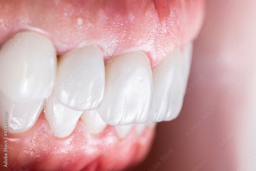 Obraz premium created new smile by crowns implants and veneers