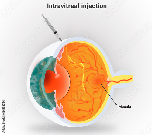 Intravitreal Injection Procedure for Macular Degeneration