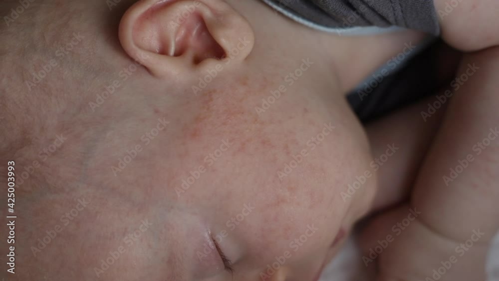 allergy atopic dermatitis eczema rash on baby's face cheeks and arms allergy atopic dermatitis eczema rash on baby's face cheeks and arms