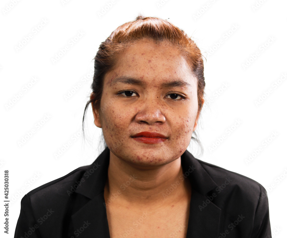 Fototapeta premium Female facial skin disease