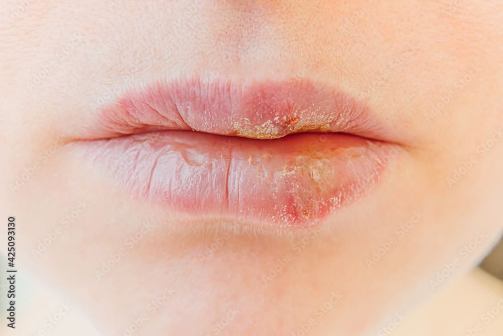 Naklejka premium Close up of girl lips affected by herpes. Treatment of herpes infection and virus. Part of young woman face, lips with herpes affected. Beauty dermatology concept.