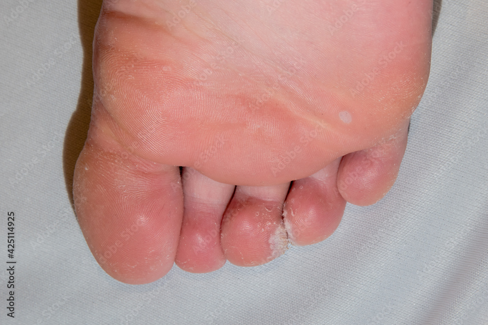 Sole of foot showing mosaic plantar wart verrucas between toes with dry rough skin Sole of foot showing mosaic plantar wart verrucas between toes with dry rough skin