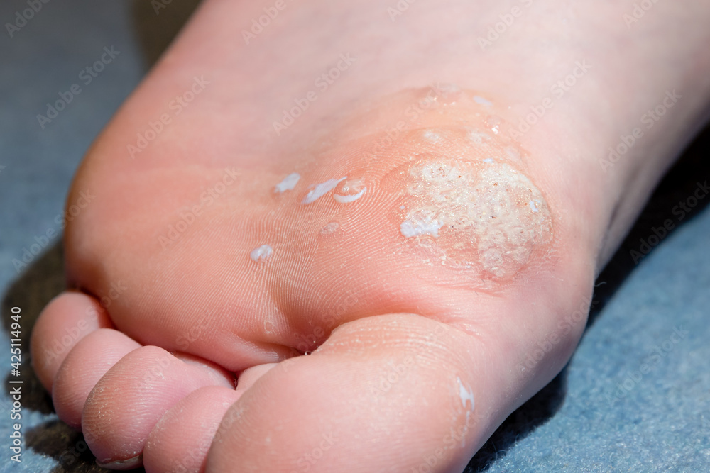 Sole of foot showing salicylic acid treatment of mosaic plantar wart and other verrucas Sole of foot showing salicylic acid treatment of mosaic plantar wart and other verrucas