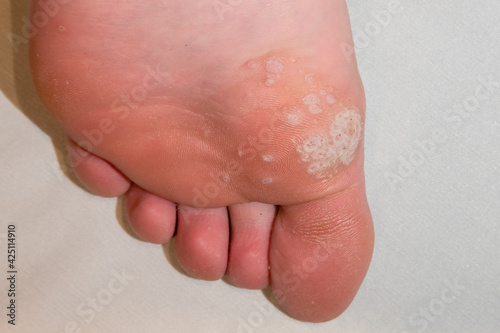 Sole of foot showing mosaic plantar wart and other verrucas including the black spot clotted blood vessel centres photo