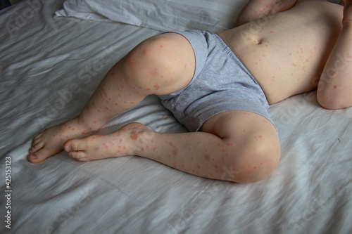 Photos A toddler boy with rash infected by Roseola Disease